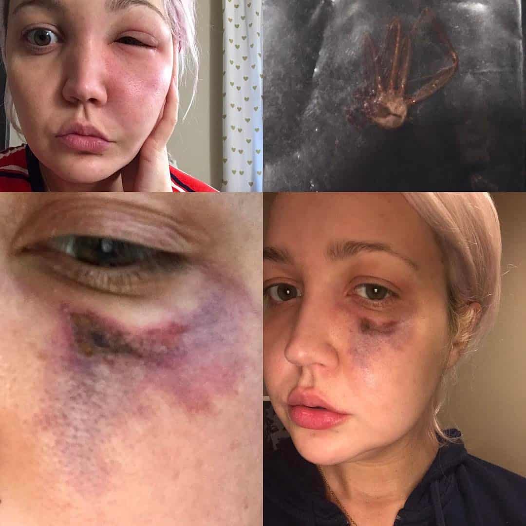A forma que ela conseguiu essa cicatriz no rosto vai fazer você perder o sono!