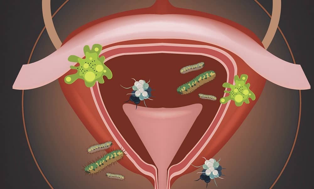 Quais são os sintomas e as causas de uma infecção urinária?