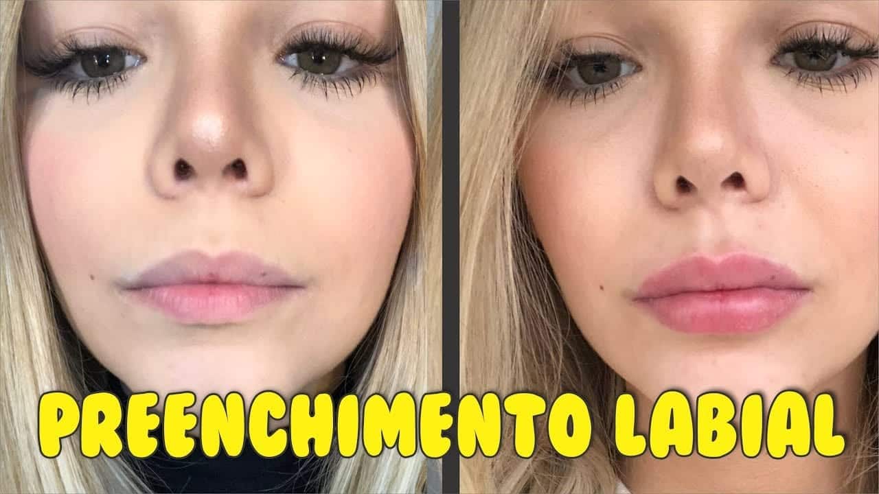 O que é o preenchimento labial, quanto custa, contraindicações