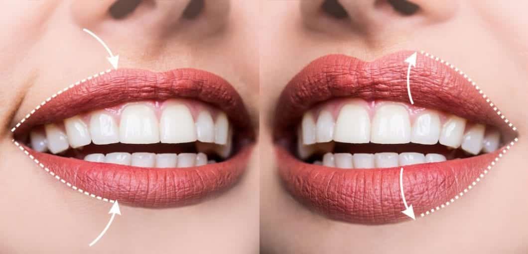 O que é o preenchimento labial, quanto custa, contraindicações