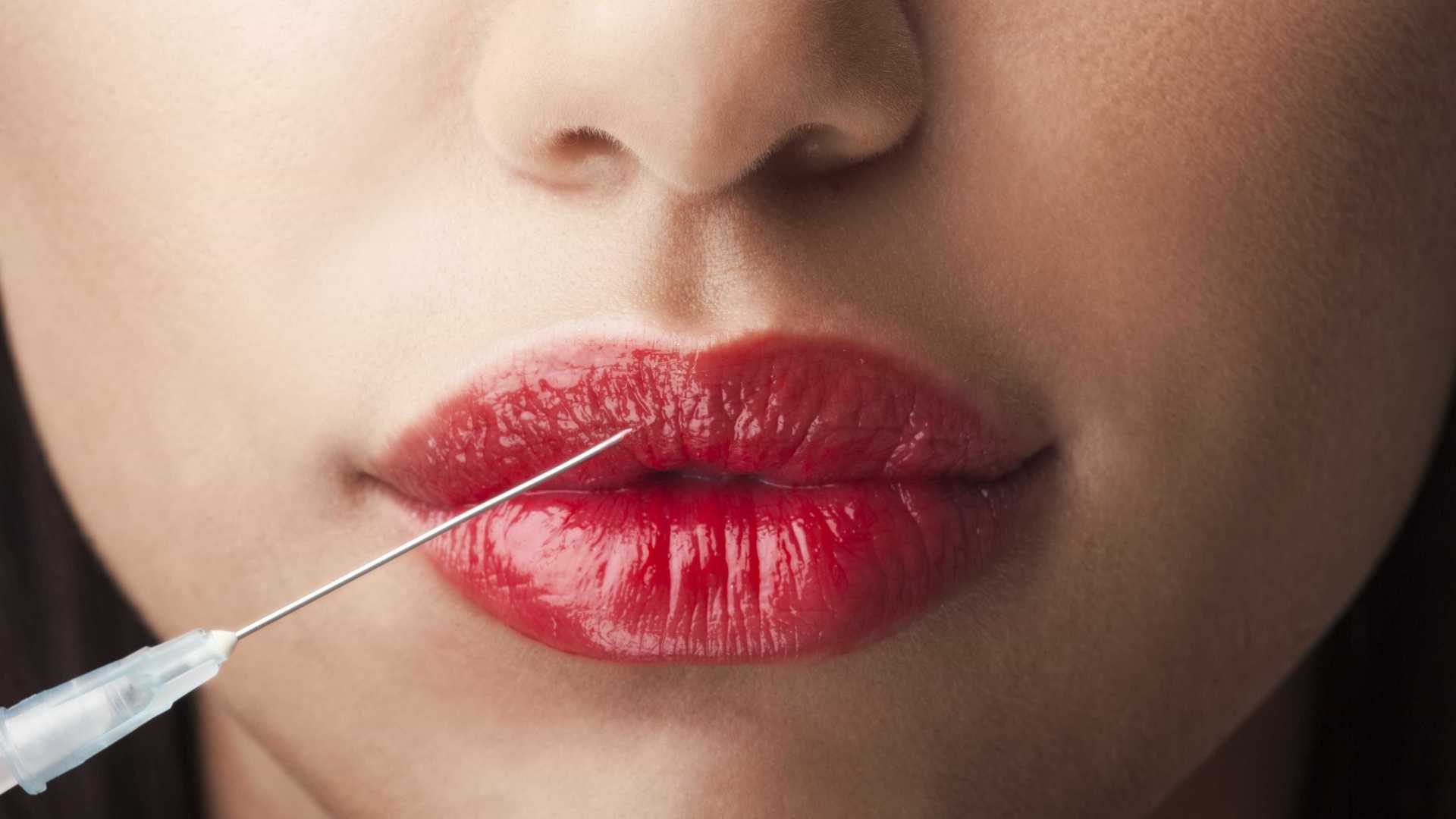 O que é o preenchimento labial, quanto custa, contraindicações